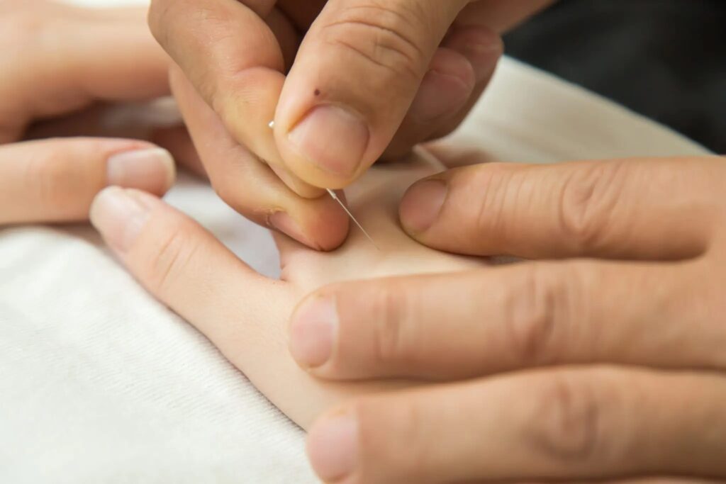 Step4:手の甲・親指と人差し指のあいだ(合谷付近)へ、極めて細い鍼をやさしく打つクローズアップ。妊娠力を高める「妊娠するツボ」を痛くない鍼で刺激し、鍼が苦手な方にも配慮しながらからだの巡りを整える工程の説明用写真|山下針灸房(姫路市・妊活鍼灸)
